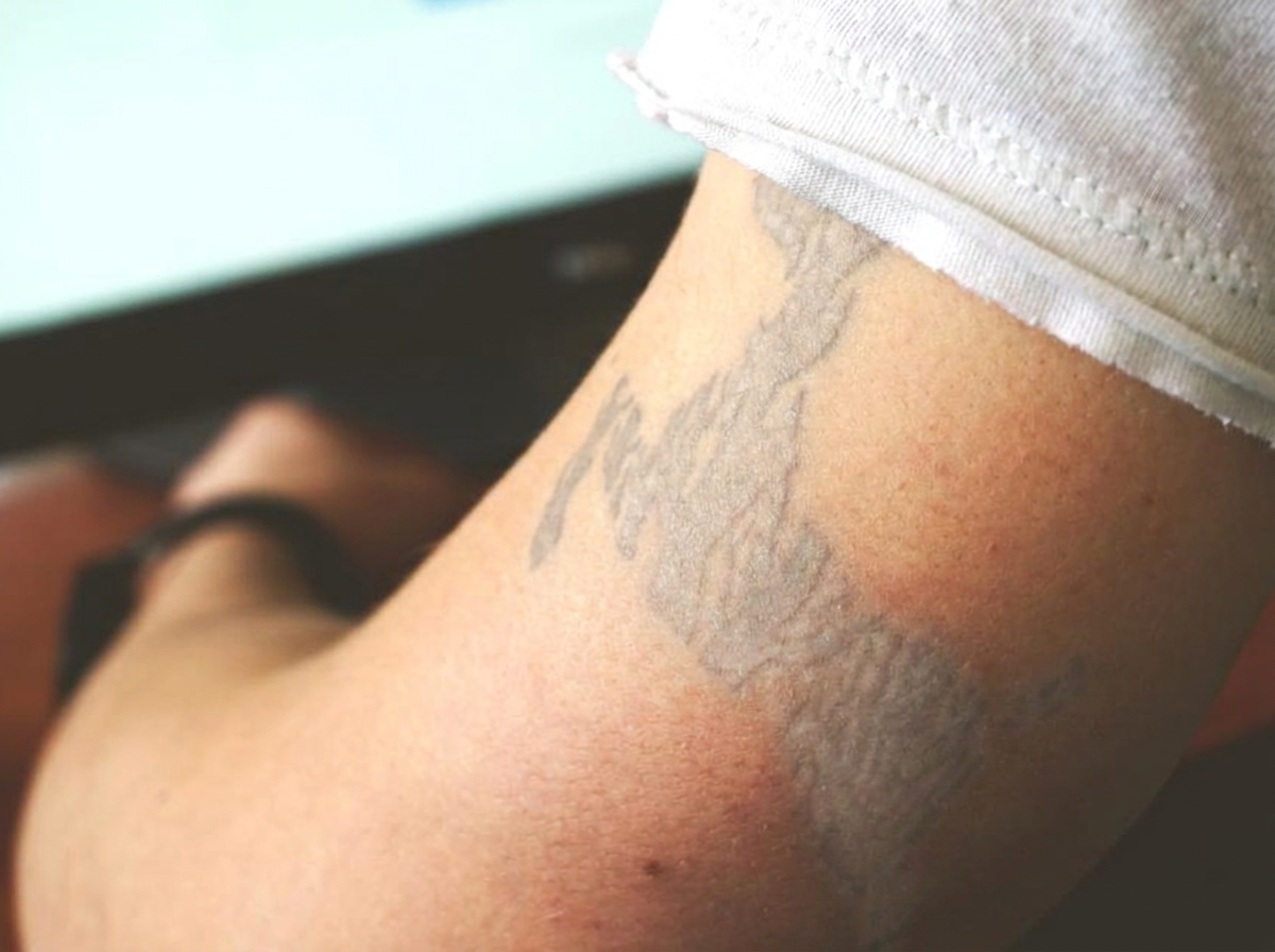 Tatoeage op de arm voor en na laser tattoo removal